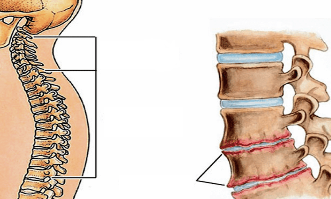 What does the osteocondrosis like the spine look like