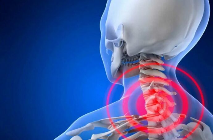 Osteocondrosis of cervical waist