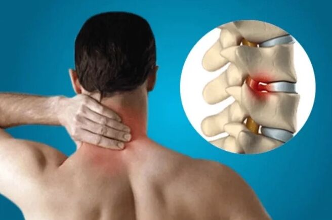 Osteocondrosis of the spine