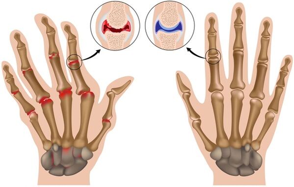 Deformation of fingers due to arthrosis
