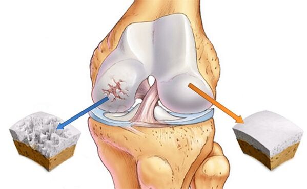 Healthy cartilage and cartilage affected by arthrosis