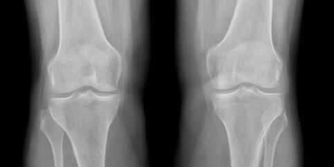 X-ray knee arthrosis