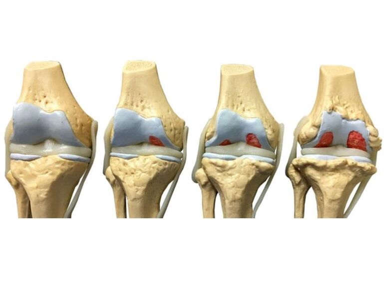 the degree of arthrosis of the joints